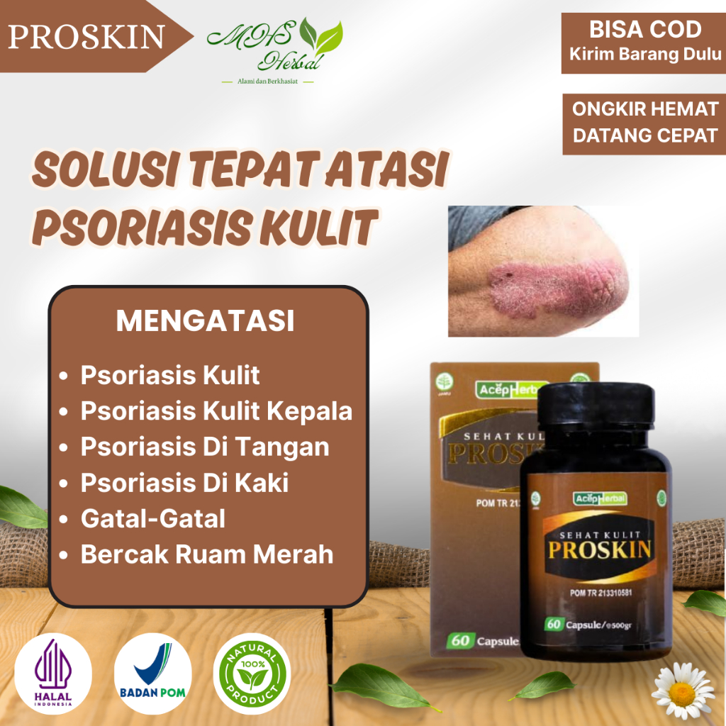 Obat Psoriasis, Kulit Berkerak, Gatal-Gatal, Ruam Merah, Psoriasis Kulit Kepala, Psoriasis Di Tangan