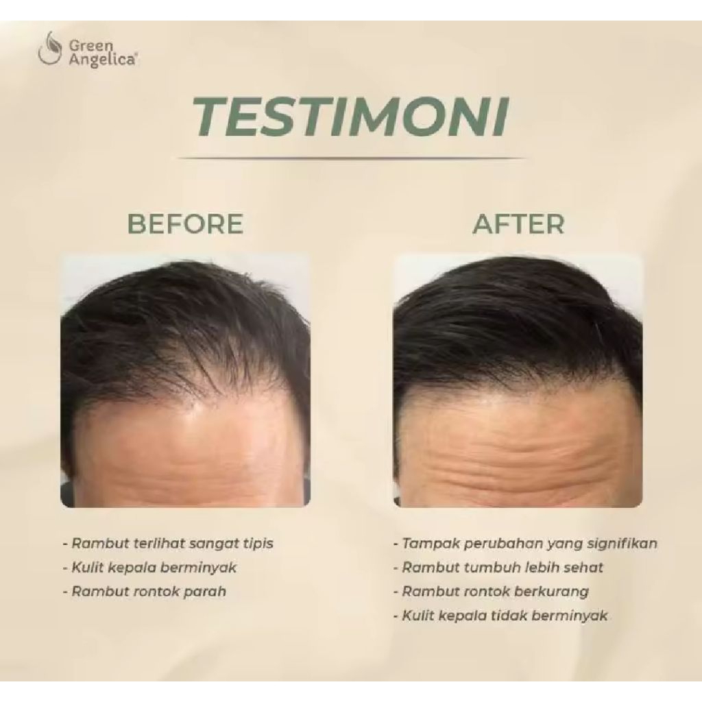 Saw Palmetto Suplemen Obat Penumbuh Rambut Botak,suplemen penumbuh rambut rontok tipis Menjaga Keseh