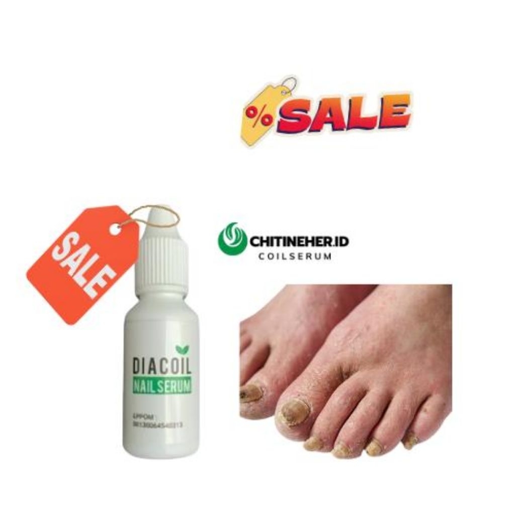 DIACOIL NAIL SERUM ORIGINAL | OBAT JAMUR KUKU | CANTENGAN DAN BERNANAH AMPUH100%