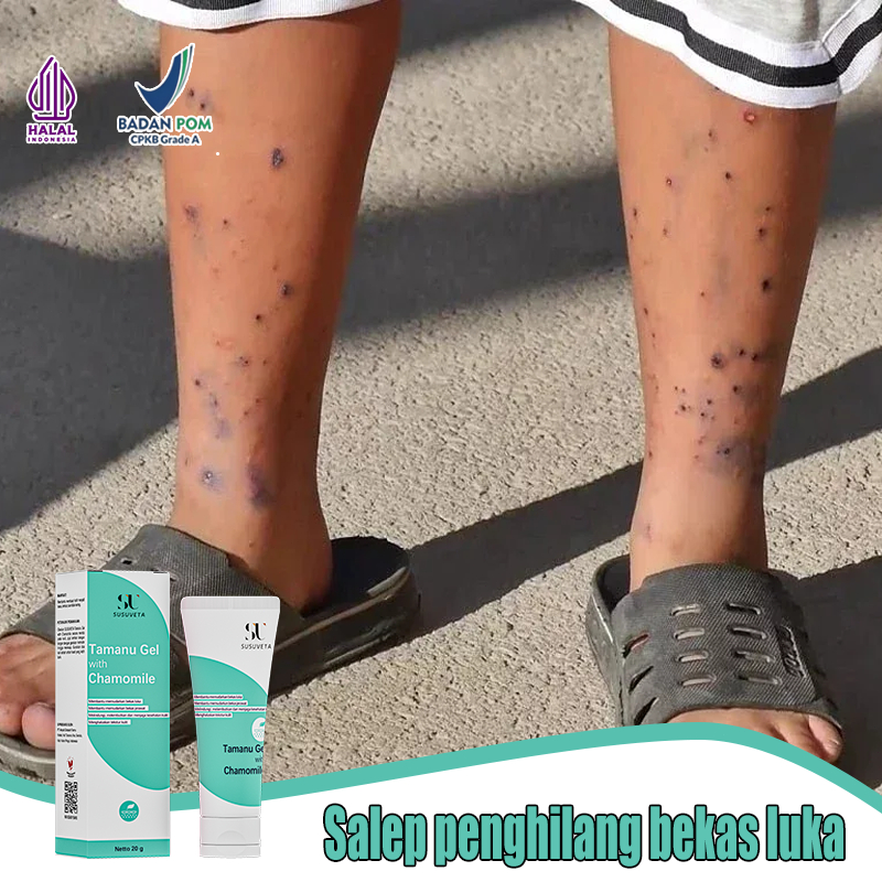 SUSUVETA Penghilang bekas luka hitam koreng Bio herbal penghilang bekas luka Salep keloid paling amp