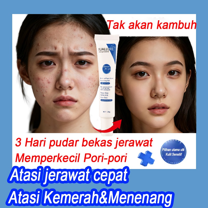 IUALLURE Acne Cream Jerawat Bekas Removal 20g/Gel Jerawat/Salep wajah jerawat/Gel Penghilang Bekas J