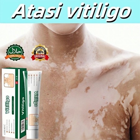 ORIGINAL Obat Penghilang Vitiligo Salep Krim Vitiligo Bintik Putih Salep vitiligo Obat vitiligo untu