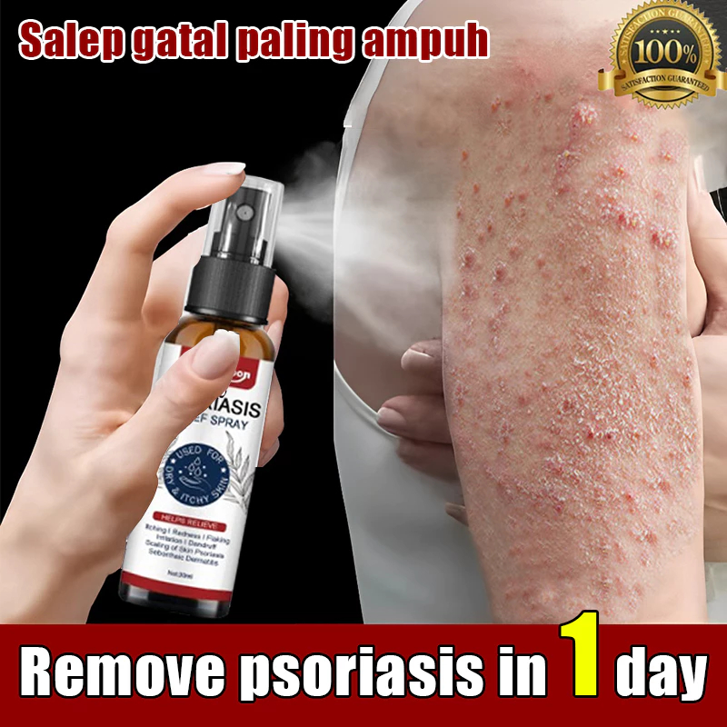 Salep gatal paling ampuh Obat psoriasis obat gatal salep kutil Obat Gatal Salep gatal Salep psoriasi