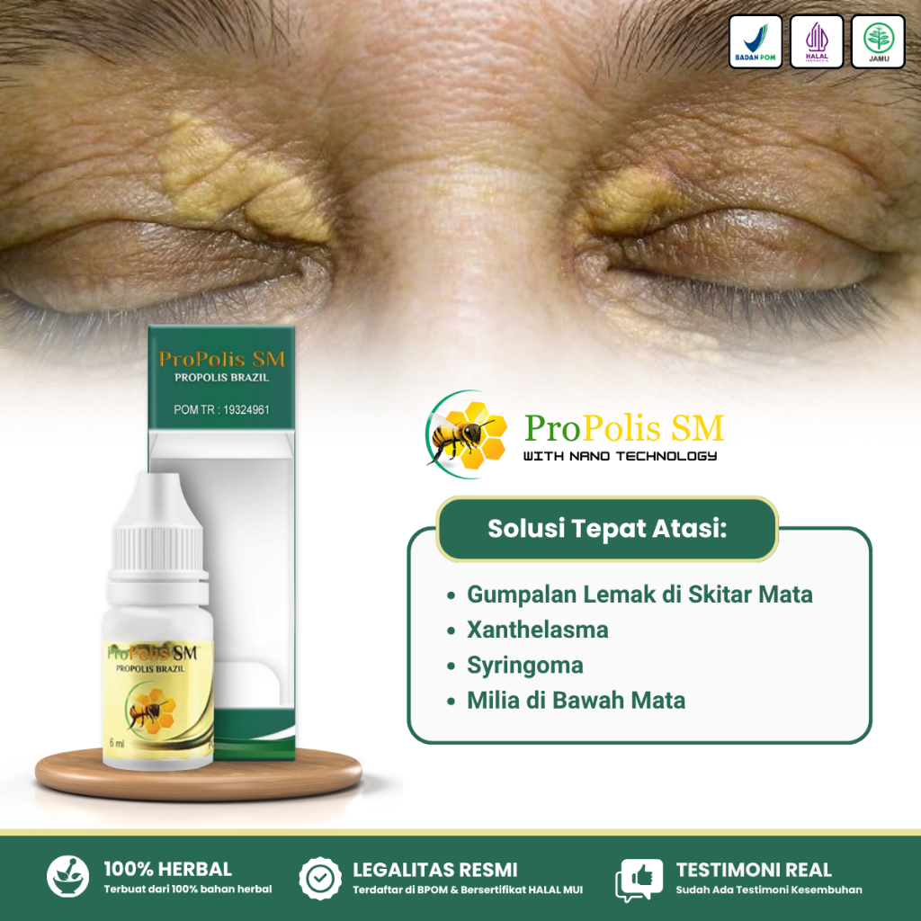 Obat Gumpalan Lemak di Kelopak Mata Penghilang Xanthelasma Syringoma Milia di Bawah Mata Propolis SM