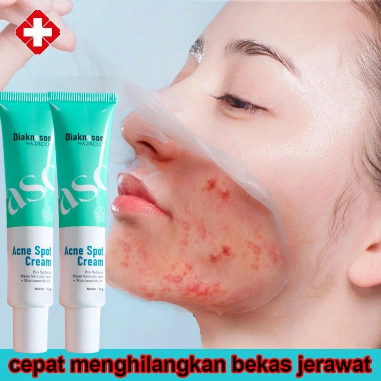 Acne Cream salep Jerawat dan bekas Removal cream Obat jerawat Gel Bekas jerawat Lotion Acne Cream sa