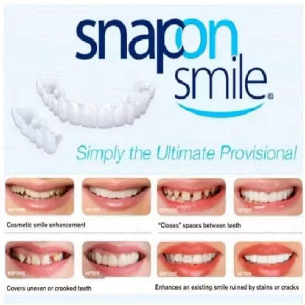 Snap On Smile Gigi Palsu / Snap On Smile Gigi Palsu 1 Set Atas Bawah