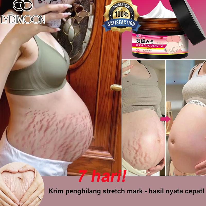 Stretch Mark Cream Strechmark Ibu Hamil Penghilang Strechmark Cream Stretch Mark Paling Ampuh30G Cepat Formula Lembut Dan Ringan Di Kulit