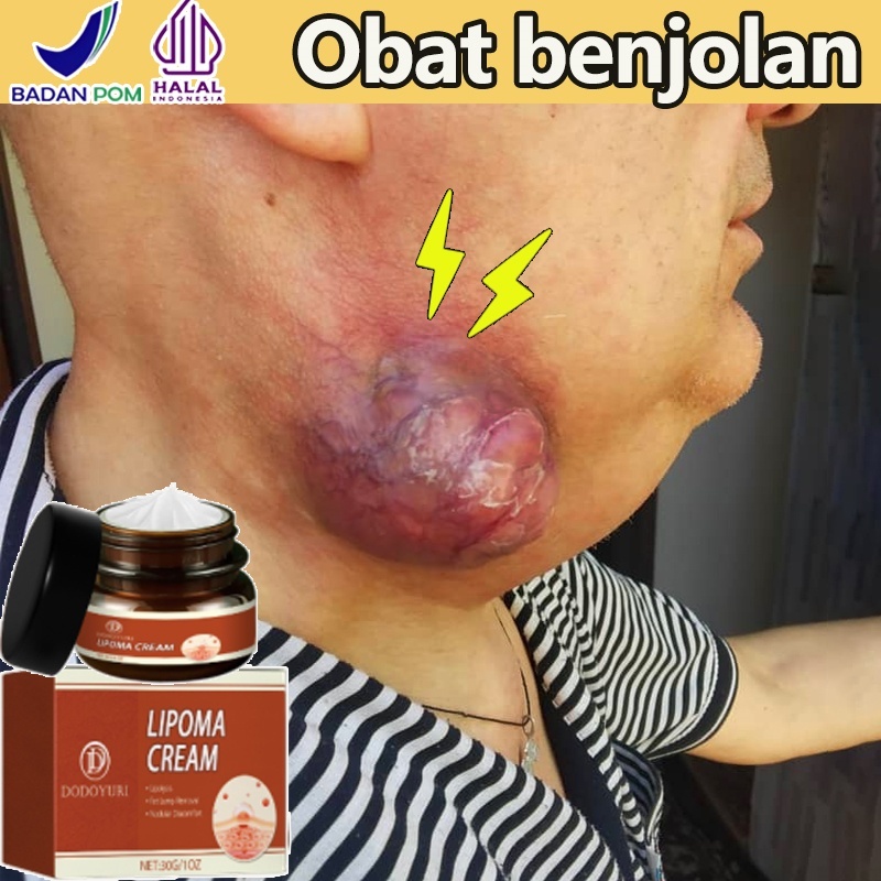 Obat benjolan Lipoma removal cream original Lipoma krim untuk benjolan Lipoma salep benjolan ampuh 3