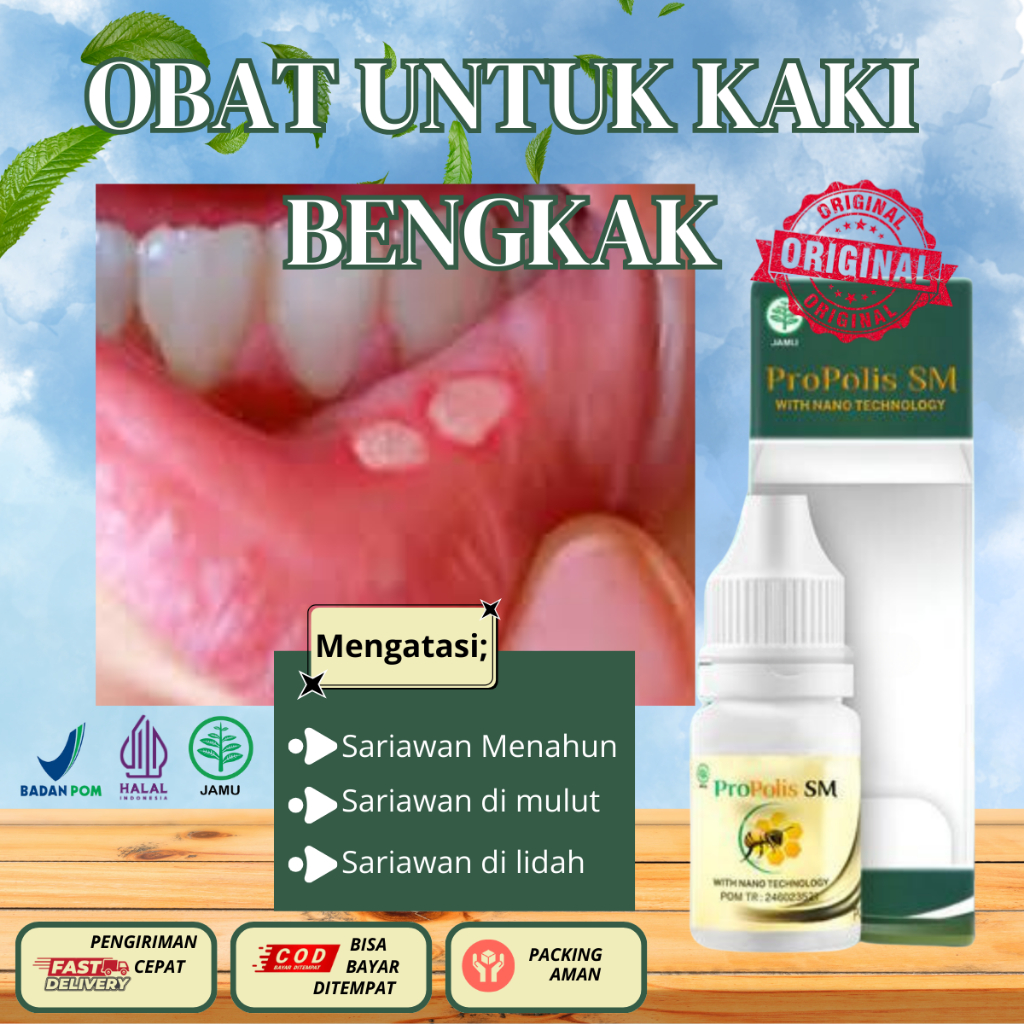 Obat Sariawan, Sariawan Di Mulut, Radang Gusi, Benjolan di Bawah Bibir, Sariawan Menahun-Aman Jika T