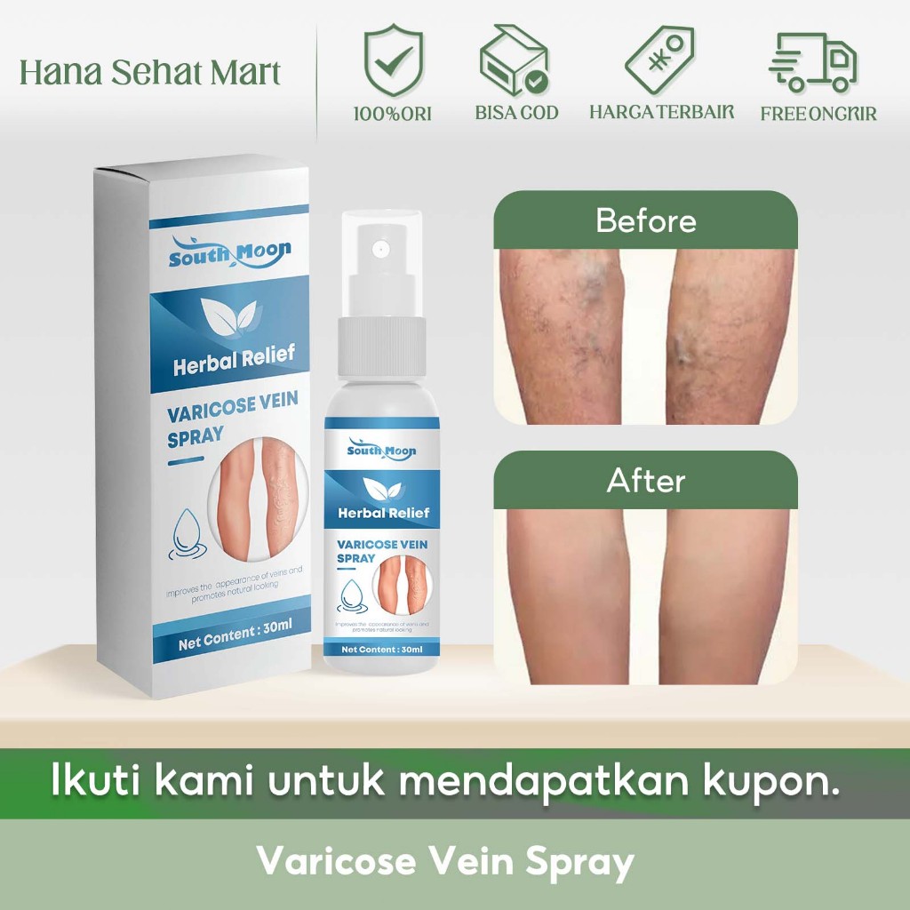 South Moon Varicose Vein Spray 30ml Penghilang Varises Menghilangkan Rasa Sakit Semprotan Perawatan 