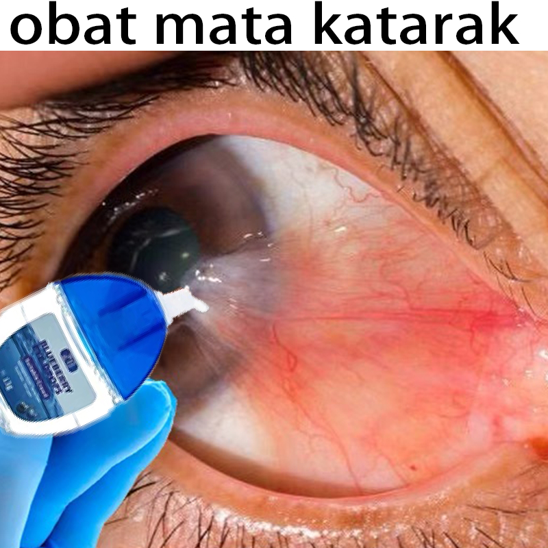Obat mata katarak Blueberry Eye Drop Obat mata merah Pengobatan Mata buram Mata bengkak Mata kering 