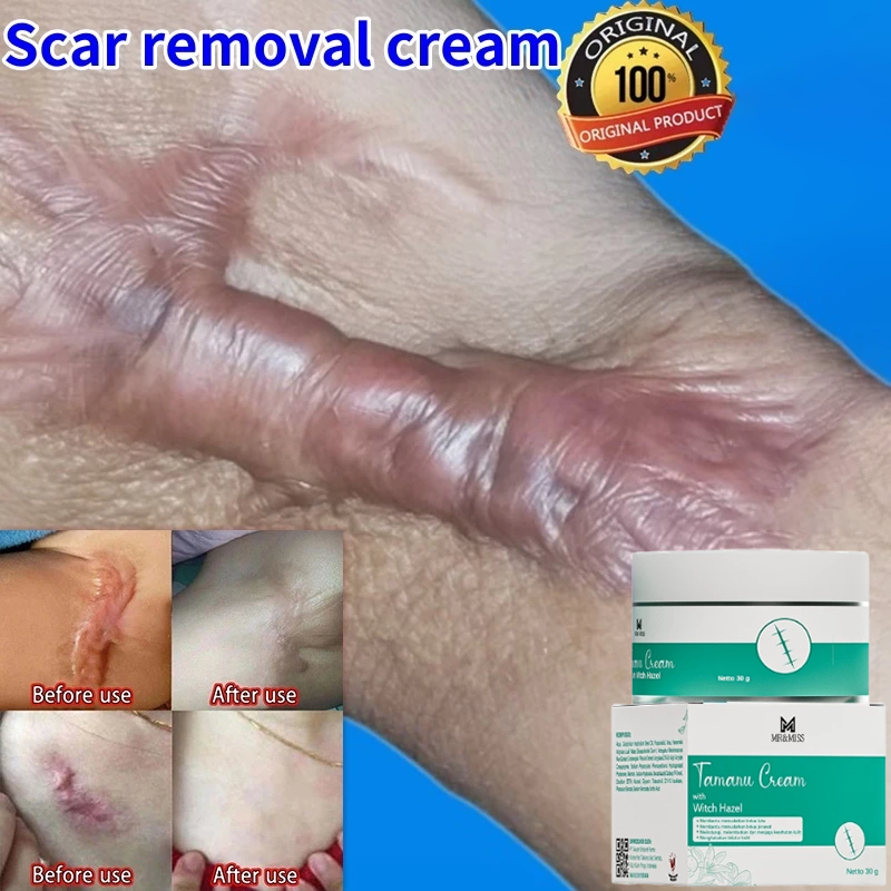 penghilang bekas luka hitam koreng salep penghilang bekas luka salep penghilang bekas luka obat peng