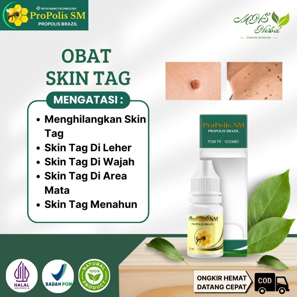 Obat Skin Tag, Penghilang Skin Tag, Memudarkan Skin Tag, Perontok Skin Tag Di Leher, Skin Tag Di Waj