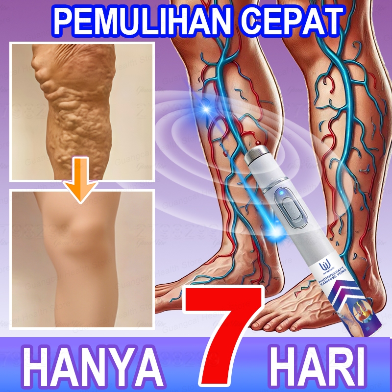 Pena terapi laser untuk perbaikan kaki, meningkatkan sirkulasi darah, dan mengatasi varises dengan s