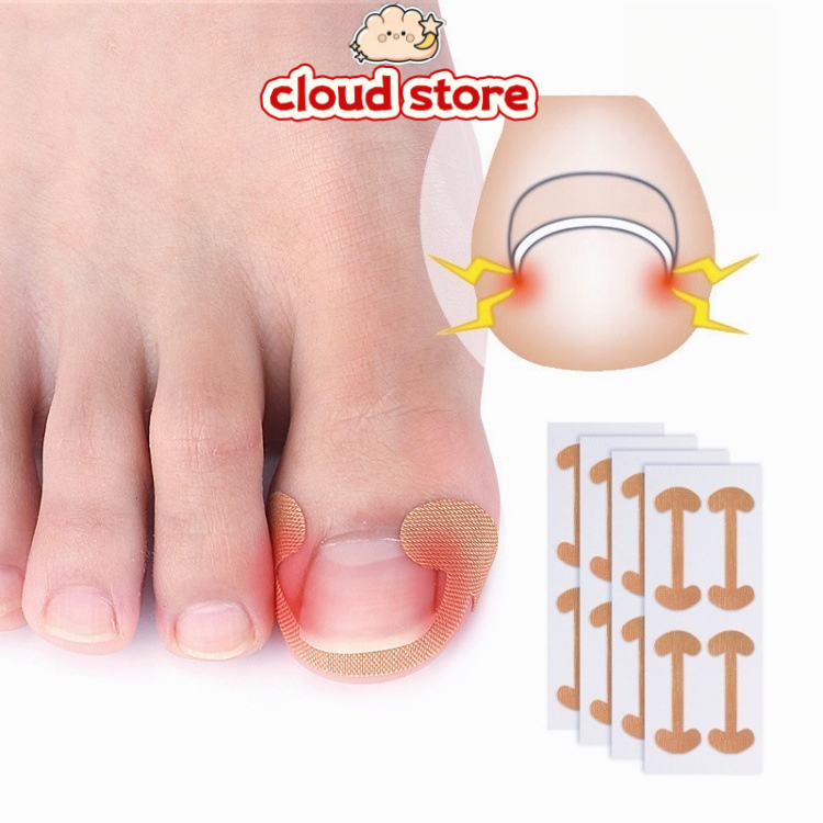 Bantalan Silikon Koreksi Perawatan Kuku Ingrown Nail Isolation Pad Cantengan Treatmen Kuku