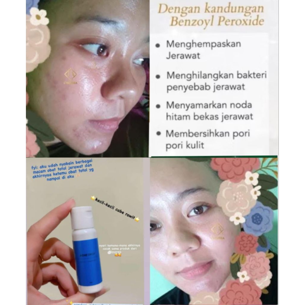 [Terlaris] Acne drop Louvrea skincare cepat keringkan jerawat, bruntus, kemerahan.