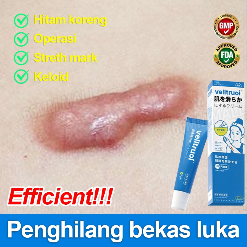 Salep Penghilang Bekas Luka Anak Menghilangkan Bekas Luka Menghitam Obat Keloid Di Kaki/Wajah Penghi