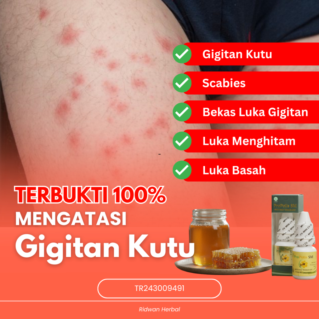 Obat Bekas Gigitan Kutu Kasur, Obat Bekas Gigitan Kutu Kucing, Obat Bekas Gigitan Tomcat, Obat Bekas