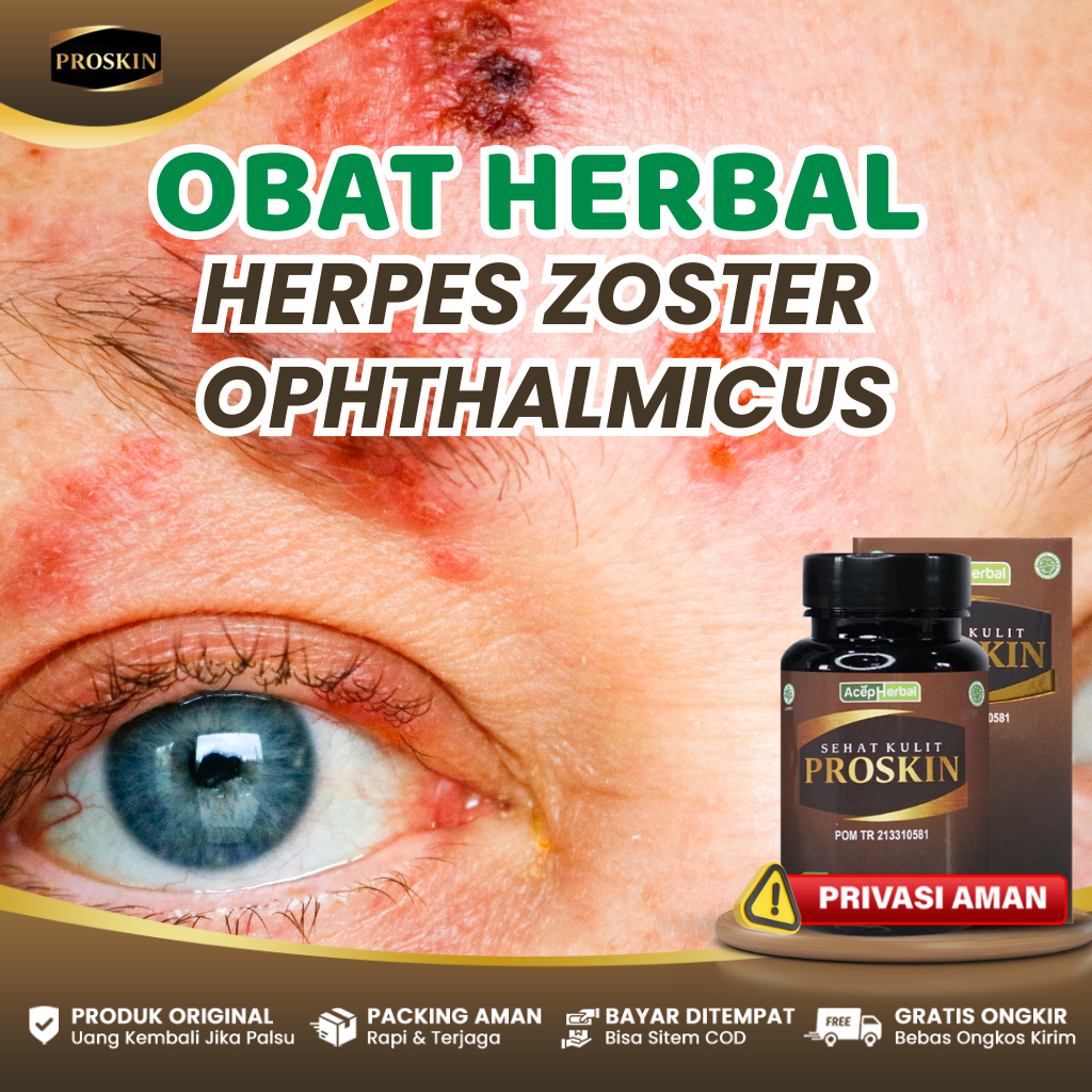 Obat Herbal Mengatasi Herpes Zoster Ophthalmicus (Mata) Dengan Proskin Asli 100% Original