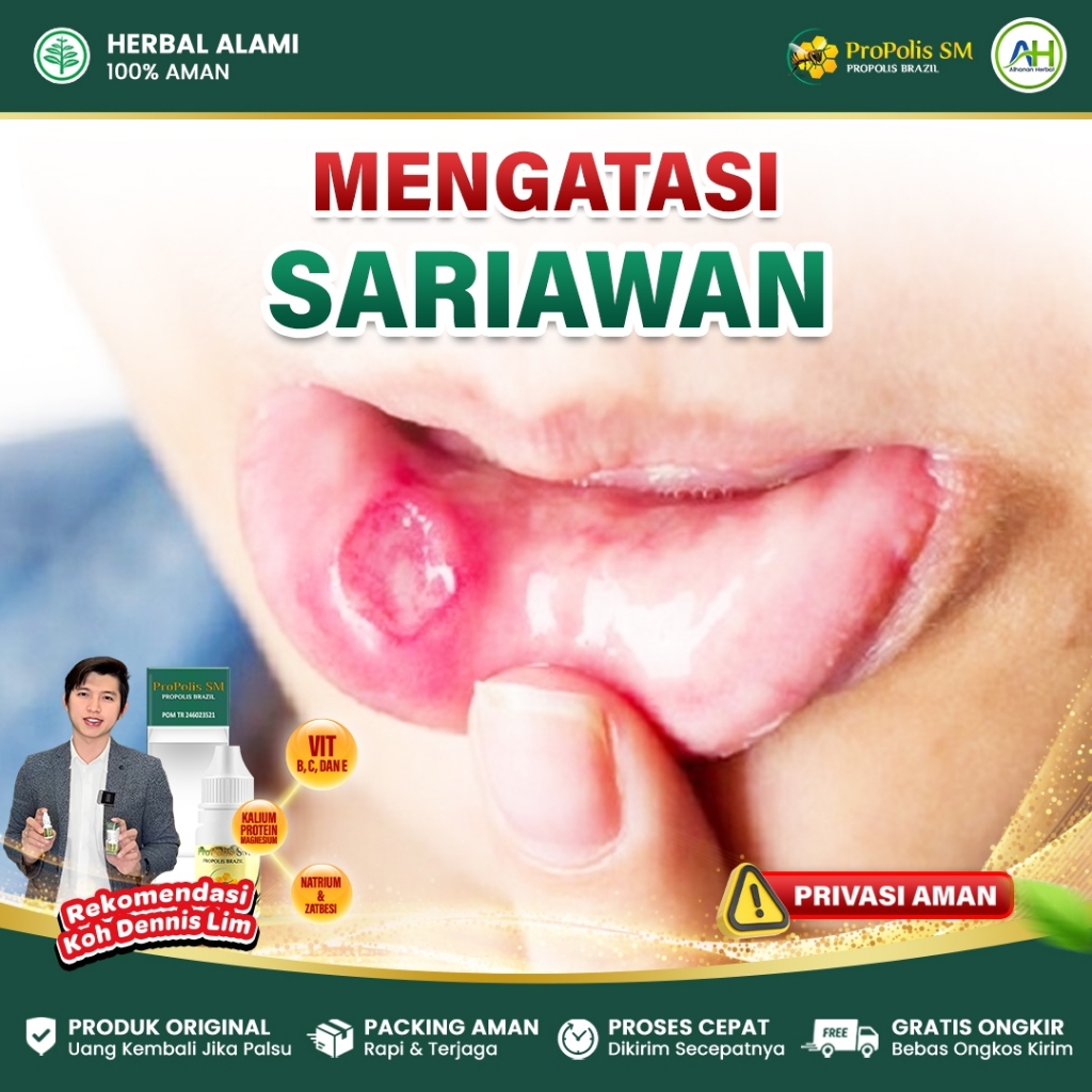 Propolis SM Obat Sariawan di Mulut, Sariawan Dilidah, Sariawan di Bibir, Radang Gusi, Mukokel