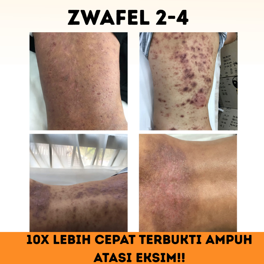 PROMO Salep Zwafel 2-4 Original BPOM Obat Scabies Anak & Dewasa Salep 24 Gatal Selangkangan Eksim QR
