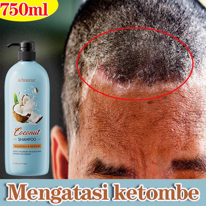 Shampo anti ketombe Penghilang Ketombe Berkerak Dan Gatal coconut oil obat ketombe kerak kulit kepal