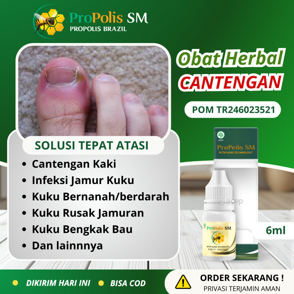 Obat Cantengan Jempol Kaki Obat Infeksi Jamur Kuku Tangan Dan Kaki Rusak Berjamur Pecah Psoriasis Ku