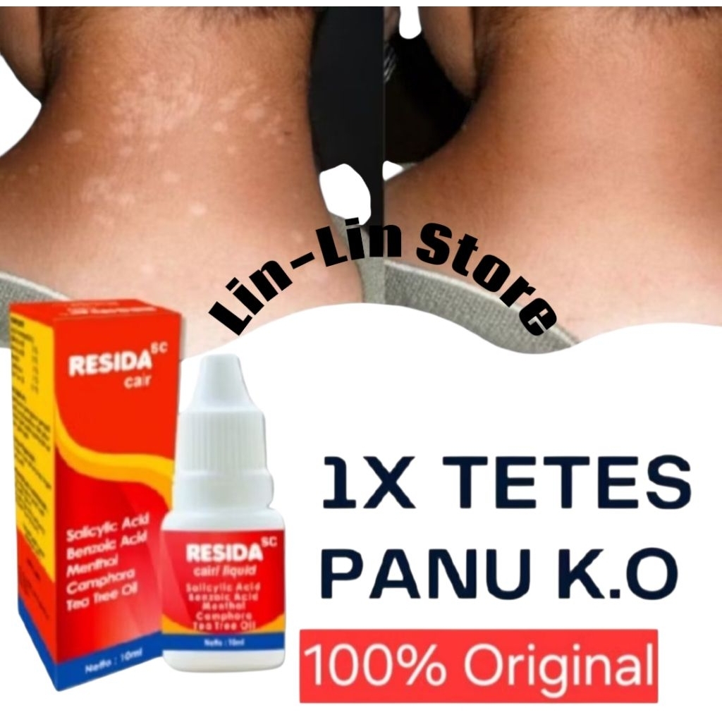ASLI 100% ORIGINAL Resida Cair Obat Panu Ampuh | Obat Kadas kurap Gatal Gatel Kutu Air Kulit Ampuh