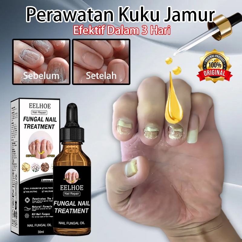 serum kuku jamur dan rusak obat jamur kuku obat kuku rusak oat kuku rusak dan jamur fungal nail trea