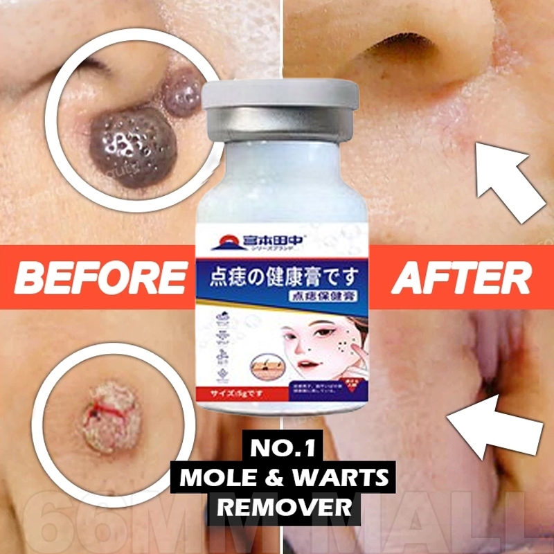 Penghilang tahi lalat permanen skin tag remover obt tahi lalat penghilang original menghilangkan tah