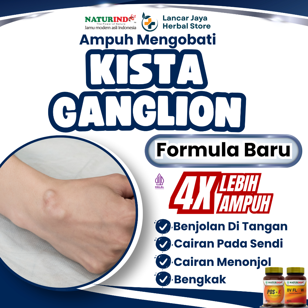 Obat Kista Ganglion Benjolan Ditangan Bengkak Herbal Posk Naturindo