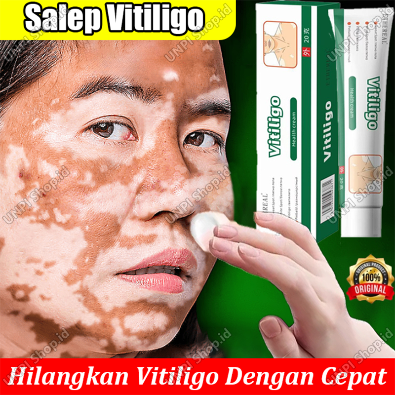 Salep Vitiligo Paling Ampuh Obat Vitiligo Cream Original Salep Khusus Untuk Vitiligo Salep Kulit Pan