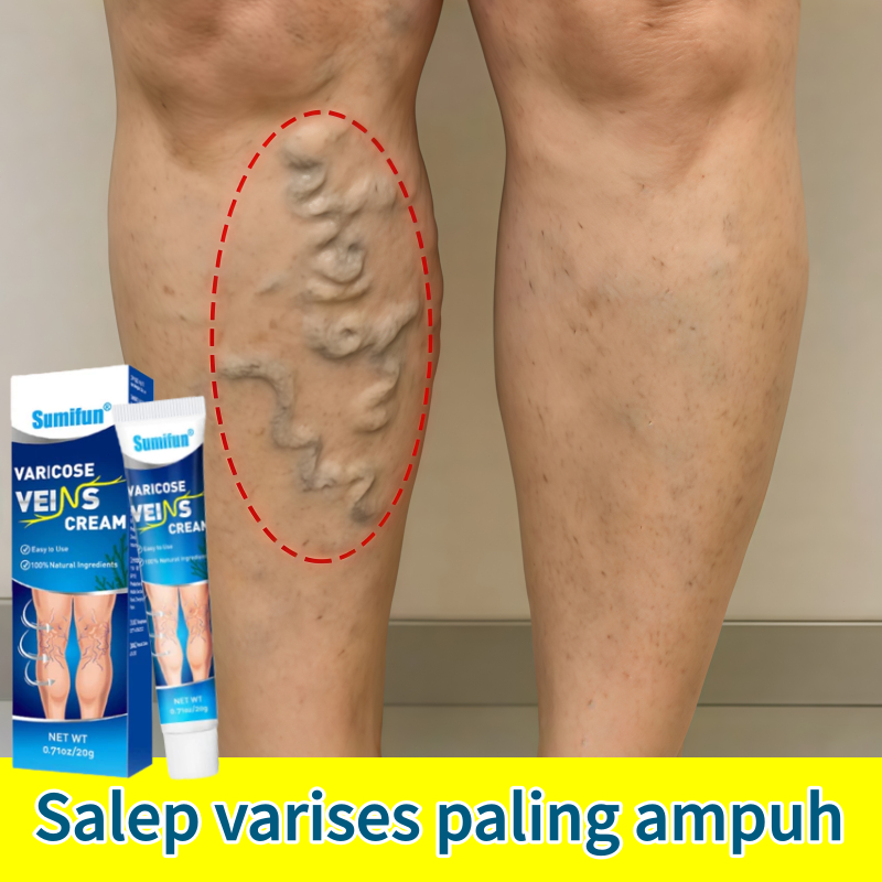 Obat varises Salep varises paling ampuh Varicose veins cream Krim Varises Di Kaki Dan Betis Menghila