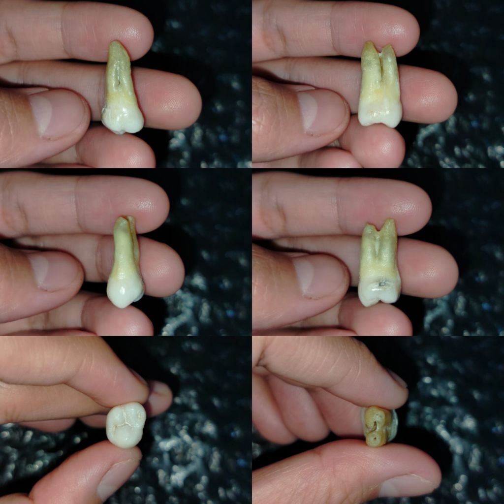 Gigi Molar 17