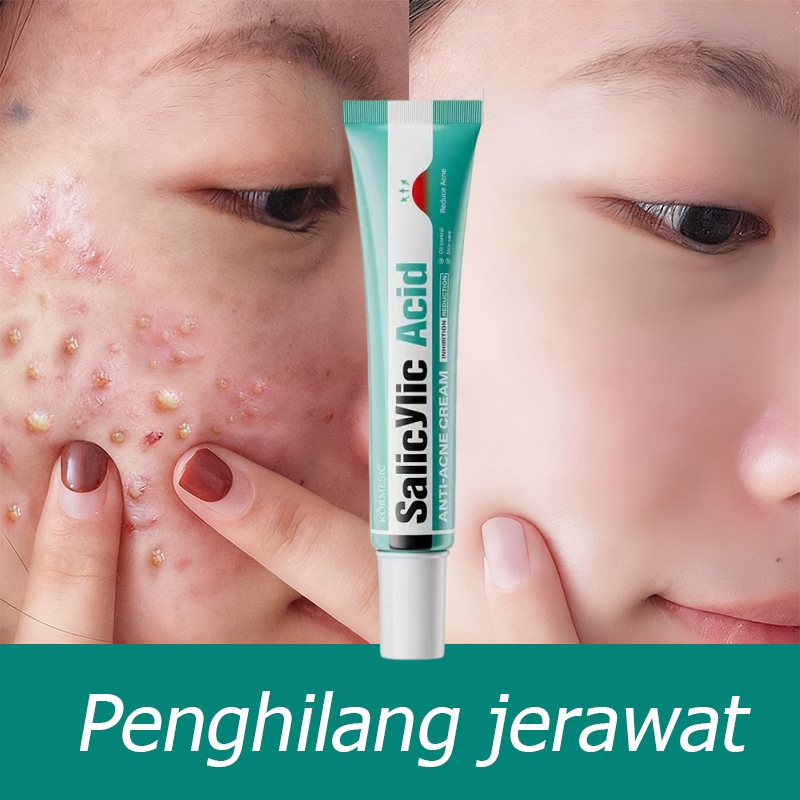 Asam salisilat obat totol jerawat obat jerawat penghilang bekas jerawat salep jerawat paling ampuh 3