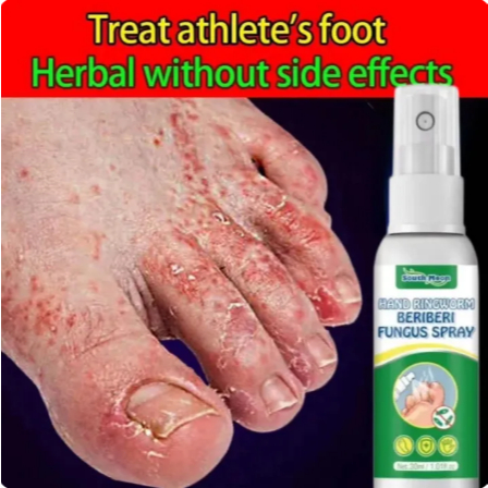 South moon Salep kulit spray Psoriasis Salep Gatal Psoriasis spray/ Antibacterial spray Eksim Infeks