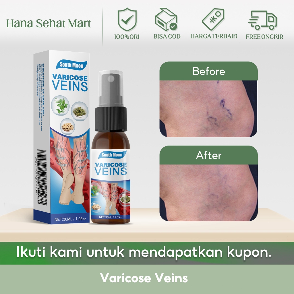 South Moon Varicose Veins 30ml Salep Varises Untuk Menghilangkan Cacing Tanah Dan Semprotan Pengobat