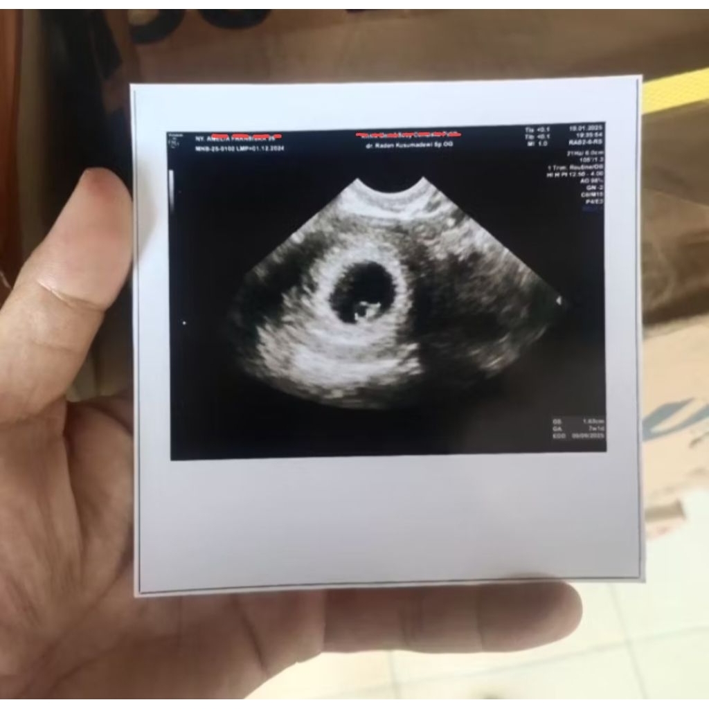 Jasa edit foto USG untuk prank, untuk pribadi saja