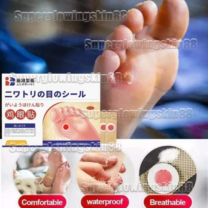 Koyo Kaki Ampuh Jepang Asli 12pcs - Corn Patches Plester Penghilang Kutil, Kapalan & Mata Ikan, Cepa