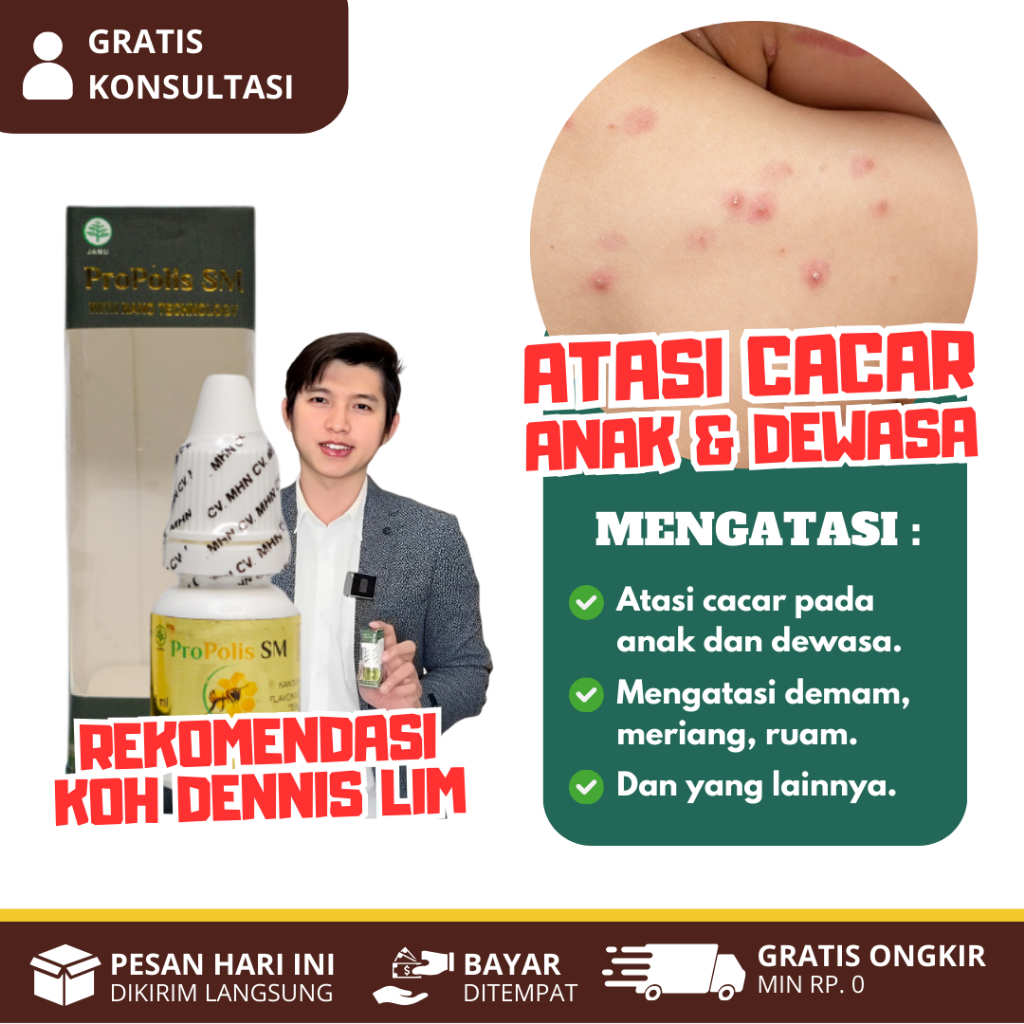 Obat Cacar Anak Dan Dewasa, Cacar Air / Api, Cacar Monyet, Cacar Ular, Cacar Singapura - Propolis SM