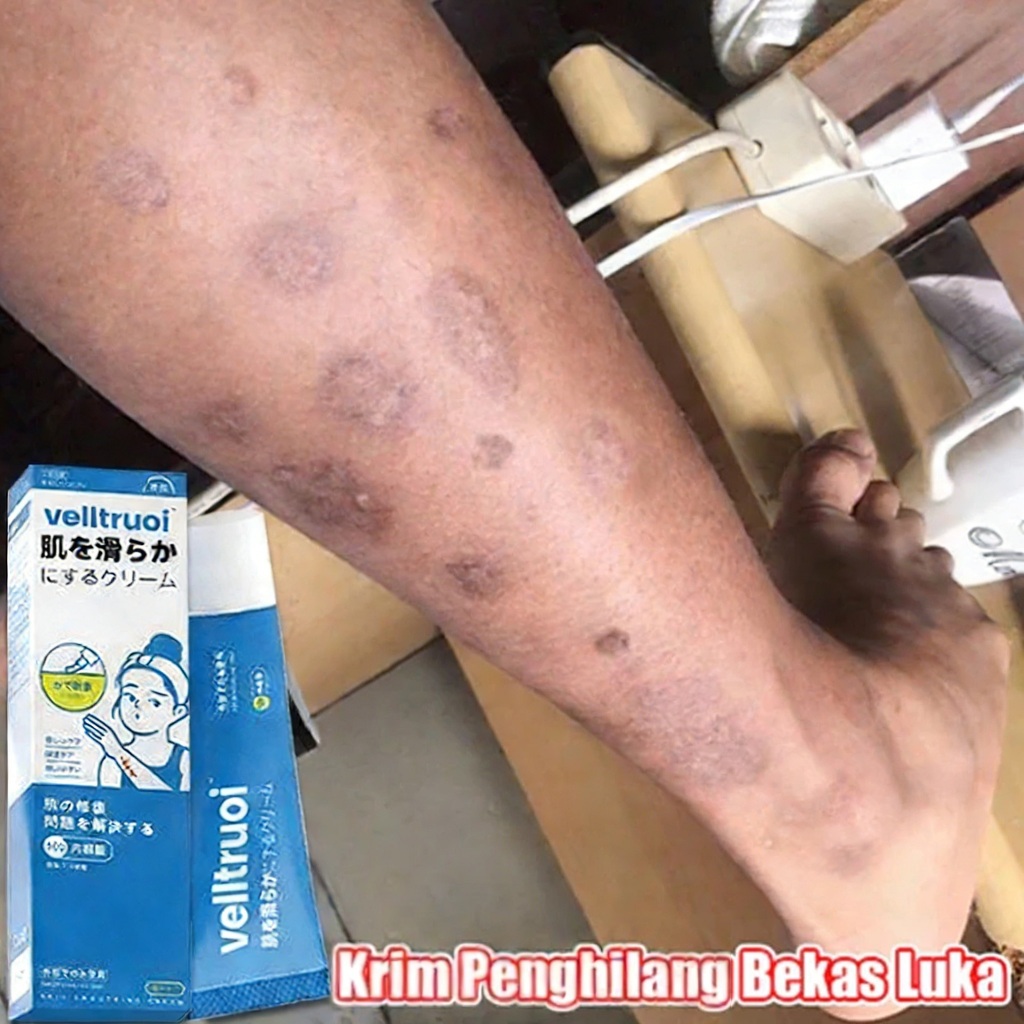 Krim Penghilang Bekas Luka Hitam Koreng Obat Penghilang Bekas Luka Menghilangkan Bekas Jerawat Jahit