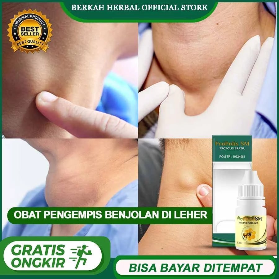 Propolis SM Original Asli Untuk Obat Benjolan ditangan, Benjolan dileher, Lipoma, Benjolan di telapa