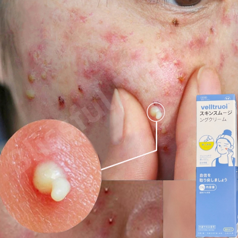 Salep jerawat penghilang jerawat bekas jerawat dan bekas jerawat hitam membandel Mengurangi Peradang