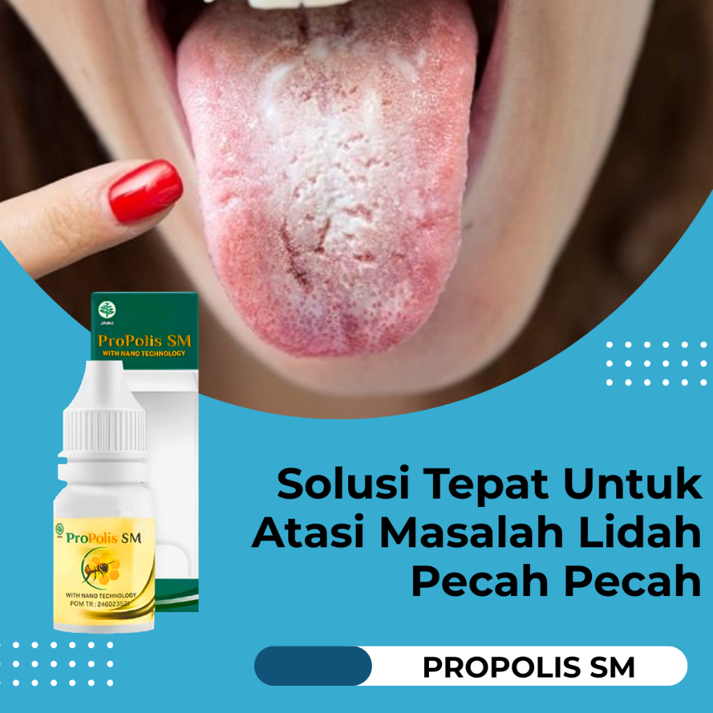 Obat Untuk Lidah Pecah Pecah Radang Lidah Putih Berjamur Obat Lidah Terasa Mati Rasa - Propolis