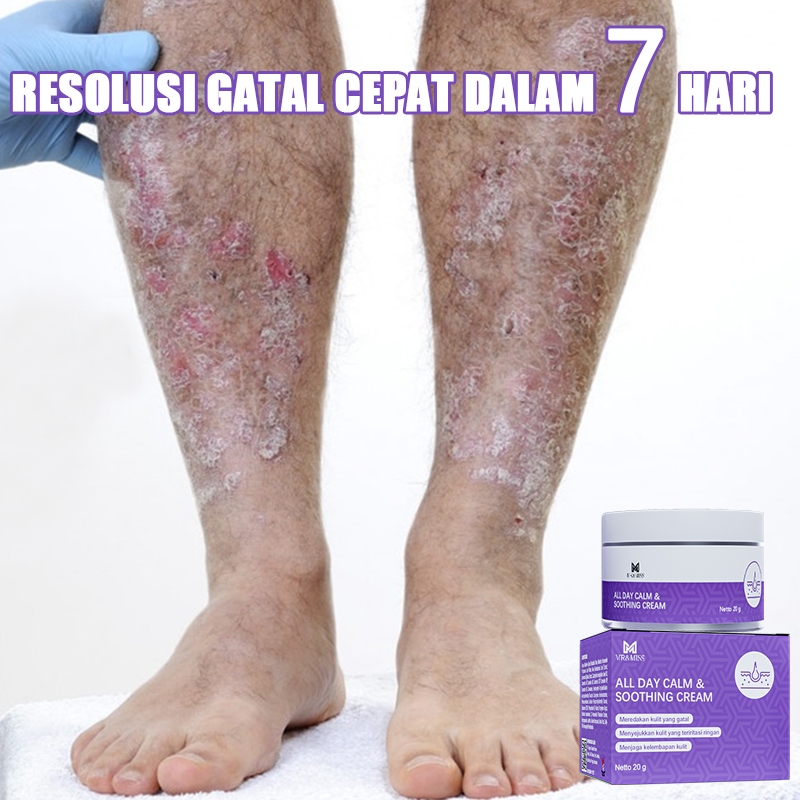 Salep eksim kering dan gatal salep china gatal paling ampuh salap gatal kulit yang ampuh 20g obt sel