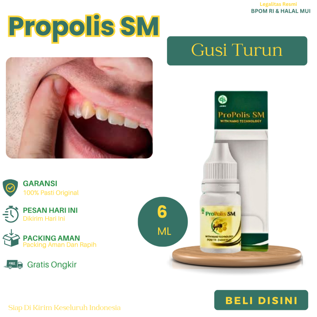 Obat Gusi Turun, Resesi Gusi, Gusi Turun Karena Behel Gigi, Sakit Gusi Turun Atasi Dengan Propolis S