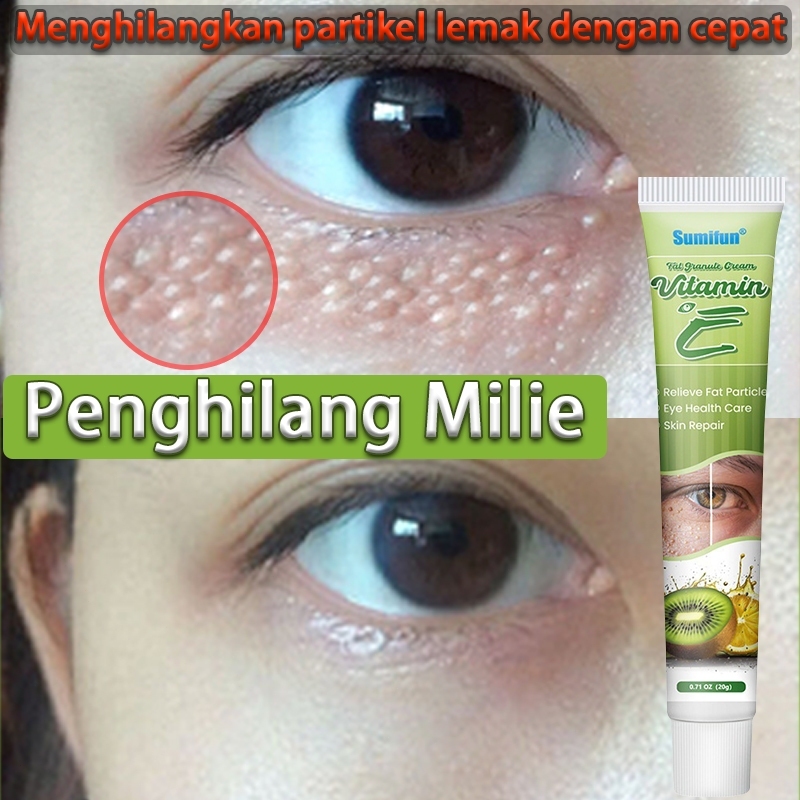 Cream Krim Salep Obat Penghilang Milia butiran lemak sekitar mata Paling Ampuh