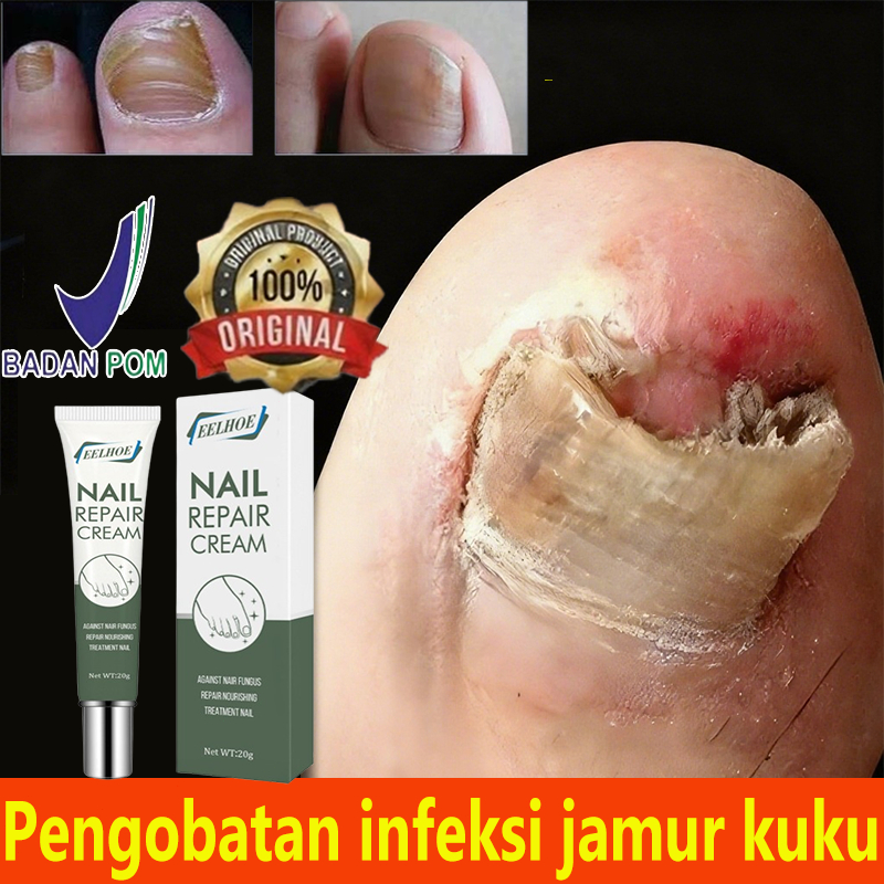 Obat Kuku Penghilang Jamur Obat Kuku Rusak Obat Kuku Jamur 20g Obat Kuku Jamur Dan Rusak Perawatan K