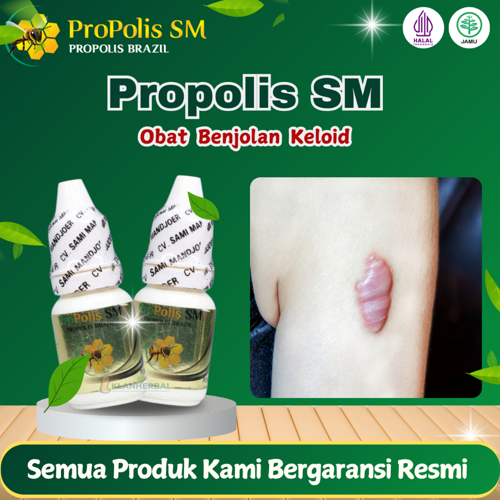 Obat Benjolan Keloid Daging Tumbuh Menahun Bekas Operasi Injeksi Di Dada Tangan Telinga Propolis SM
