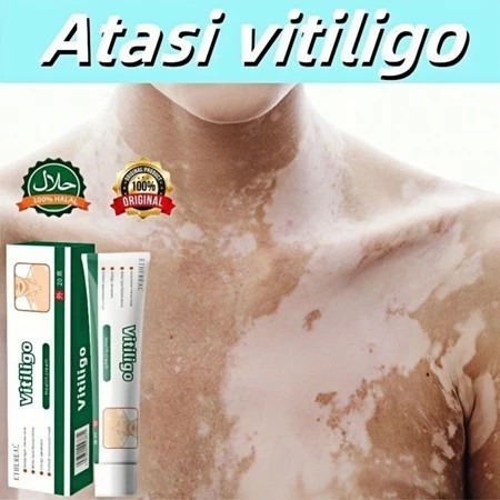 Salep Vitiligo Salep bintik putih khusus vitiligo cepat Menghilangkan Bintik Putih khusus bintik put